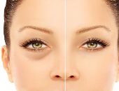 علامات تظهر على وجهك تكشف عن حالة جسدك.. منها البثور وانتفاخات العين