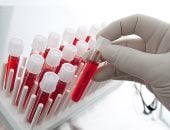 تطوير اختبار دم للتنبؤ بالإصابة بسرطان الكلى 