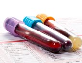 اختبار دم يكشف عن علامات الإصابة بسكر الحمل فى الشهور الأولى