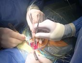 إجراء عملية جراحية لإصلاح "الشريان السباتى" لعجوز بمستشفى أسيوط الجامعى