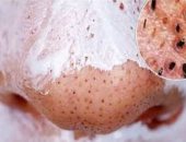 وصفات طبيعة بزيت جوز الهند وصودا الخبز لتنظيف الوجه