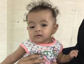 نجاح جراحة تجميل عيون لطفلة عمرها 6 شهور بمستشفى رأس سدر بجنوب سيناء