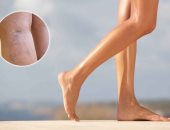 النساء أكثر عرضة للإصابة بدوالى الساقين بسبب التغيرات الهرمونية 