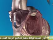 شاهد.. أول عملية زراعة جهاز تنظيم ضربات القلب دون جراحة أو تخدير بلبنان