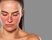 س و ج.. كل ما تريد معرفته عن أسباب وأعراض وعلاج الذئبة الحمراء