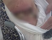 مواطنة تستغيث بوزارة الصحة بعد شلل ذراعيها نتيجة الإهمال الطبى