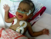 أم تستغيث لعلاج رضيعتها من قصور فى وظائف الأمعاء بتوفير "جالاكتومين 19 أو 17"