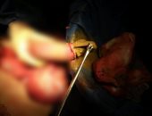 استخراج "فوطة جراحية" من بطن سيدة أجرت ولادة قيصرية منذ 4 شهور