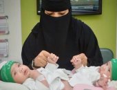 صور .. أطباء سعوديون ينجحون فى فصل توأم ملتصق فى عملية استغرقت 12ساعة