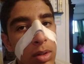 طالب ثانوى بالشرقية يضرب زميله ويتسبب فى كسر أنفه داخل المدرسة