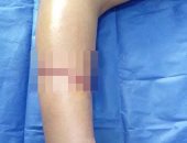 فريق طبى بجامعة الأزهر ينجح فى إعادة ساعد مبتور بمستشفى دمياط الجامعى