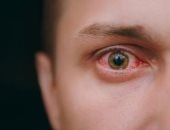 علاج نزيف العين .. الأدوية المضادة للفطريات الأبرز