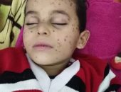 صور.. طفل مريض بسرطان الدم "بين الحياة والموت" وأسرته تطالب بعلاجه