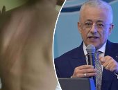 عنف المدارس عرض مستمر.. معلم بالقليوبية يضرب تلميذًا بـ"إيد مقشة".. الطفل: ضربنى بوحشية لتشاجرى مع ابنه بالفصل.. ووالده: ضربه ضرب مبرح على ظهره وأيده وعايز حق ابنى.. و"التعليم" تحيل المدرس للشئون القانونية