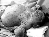 صور.. ولادة طفلة بتشوهات نادرة فى مستشفى العامرية العام بالإسكندرية