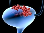 دراسة: سلالة من فيروس البرد يمكن أن تساعد فى علاج سرطان المثانة