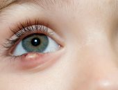 ما أسباب دمامل العين وطرق علاجها؟