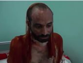 فيديو.. الحوثيون ارتكبوا جرائم تعذيب ألف يمنى باستخدام حمض الأسيد