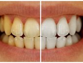 احذر 6 علامات لتراكم البلاك على أسنانك.. التهاب اللثة ورائحة كريهة للفم