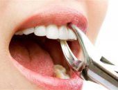 النقابة العامة لأطباء الأسنان تفتح باب شراء البنج لطلبة الجامعات بالكارنيه