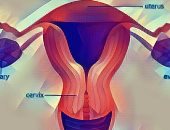 فيديو معلوماتى..4  أشياء يجب معرفتها قبل استئصال الرحم