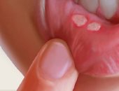 قرح الفم.. أسبابها وسر علاجها فى هذا المسحوق