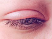 اعراض صداع العين أهمها الزغللة والألم