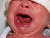  أعراض "اللسان المربوط" للأطفال حديثى الولادة وطرق العلاج