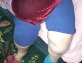 قارئة تناشد وزيرة الصحة علاجها من داء الفيل على نفقة الدولة