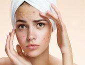 5 وصفات طبيعية لعلاج حب الشباب