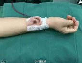 كله بالعلم.. طبيب صينى يزرع أذنًا بذراع مريض.. ونجاح إعادة ذراع أمريكية بعدما فقدته فى حادث.. وشاب يخضع لـ 51 جراحة لتحويله لشخصية خيالية.. وإصلاح لسان سيدة بقطعة من جسدها بعد فقدانه لإصابتها بالسرطان