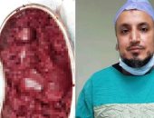 فريق طبى بمستشفى بنها للتأمين الصحى يستئصل طحال متضخم من طفل