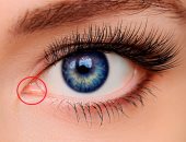  التهاب الملتحمة.. أعراضه وكيفية تأثيره على العين وطرق الوقاية