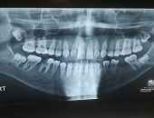 صور.. فريق طبى يثبيت فك شاب بعد كسره فى حادث بمستشفى التأمين الصحى ببنها