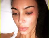 الصورة خير دليل ..ماذا فعل مرض "الصدفية " بوجه كيم كاردشيان 