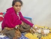 صور.. طفلة من الإسماعيلية تحتاج إلى ساق صناعية بعد إصابتها فى حادث قطار