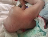 فريق طبى ببنها يستئصل ورما يزن 4 كيلو من جسد طفلة حديثة الولادة