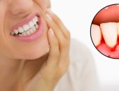 بتعاني من التهاب اللثة ووجع الأسنان.. اعرف الأسباب وطرق العلاج