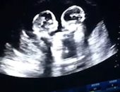 "خناقة فى الرحم".. جولة ملاكمة بين توأم صينى قبل الولادة.. فيديو صور