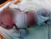 "معتز" شهرين يتألم بسبب تسمم الدم.. والدته: من يوم ما أتولد مش عارفة أحضنه