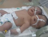 وفاة طفل بـ "رأسين  بعد ولادته بأسبوعين نتيجة هبوط حاد فى الدورة الدموية 