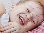 لجنة التطعيم والتحصين توصي الحكومة البريطانية بتحصين الأطفال ضد الجدري