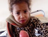  والد الطفلة "فرح" يستغيث بوزيرة الصحة لانقاذها وعلاجها قبل بتر قدمها