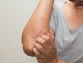التهاب الجلد الإسفنجى نوع من الالتهابات يسبب تراكم السوائل بالجسم