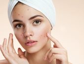 لأصحاب البشرة الدهنية.. 4 نصائح هتساعدك تحفاظى عليها فى الصيف