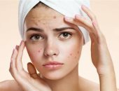 لو بتعانى من حب الشباب فى الصيف.. المواد الطبيعية هى الحل