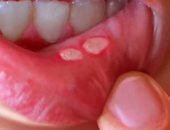 صحتك فى وصفة.. البيكربوناتو والريحان لعلاج قرح الفم