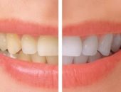 هل الأسنان الصفراء تحرجك؟.. تعرف على أسبابها وطرق العلاج