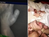 بتر إصبع طفلة حديثة الولادة فى مستشفى بالسعودية.. والممرضة: كانت ترضع إصبعها