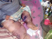 قارئ يناشد وزارة الصحة علاجه من داء الفيل